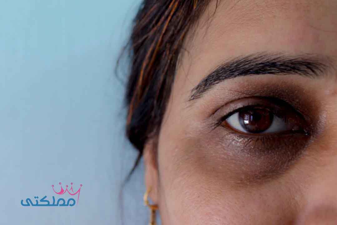 كيفية التخلص من الهالات السوداء حول العين كيفية التخلص من الهالات السوداء حول العينر