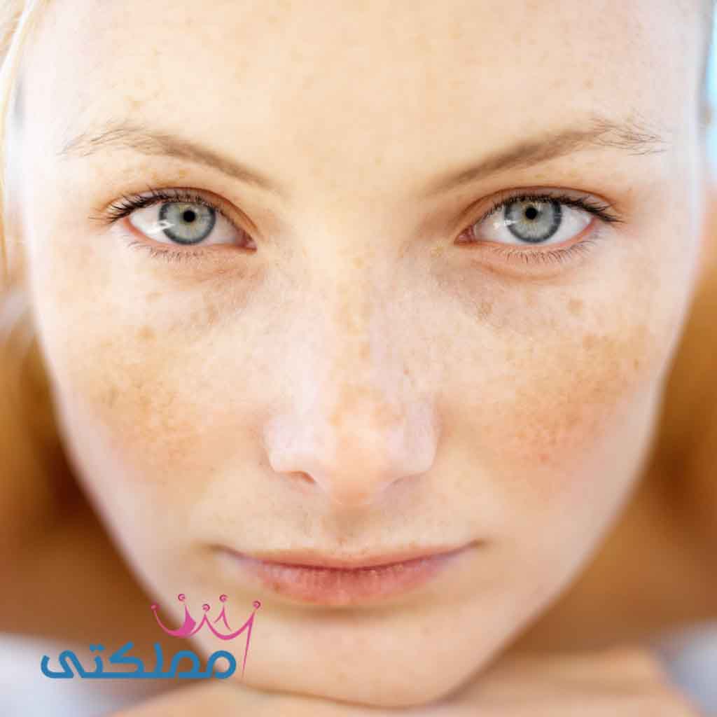 كيفية علاج البقع البنية على الوجه بطرق طبيعية خلال شهر كيفية علاج البقع البنية على الوجه بطرق طبيعية خلال شهر