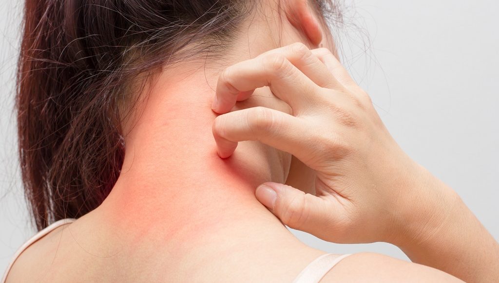 4 مكونات طبيعية تساعدك على القضاء على الناموس نهائيا