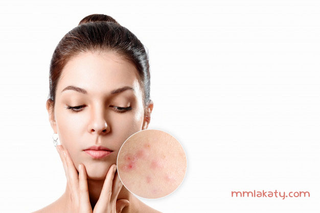 علاج حب الشباب بالليزر وأهم مميزاته وعيوبه