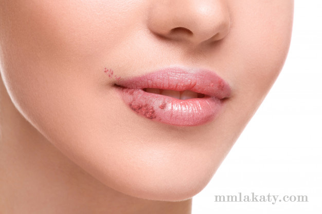 الهربس أسبابه وعلاجه