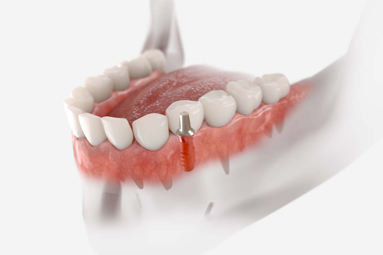 زراعة الأسنان في تركيا