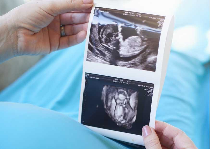 أعراض المشيمة المنزاحة أعراض المشيمة المنزاحة