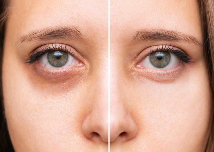 كيفية التخلص من الهالات السوداء كيفية التخلص من الهالات السوداء