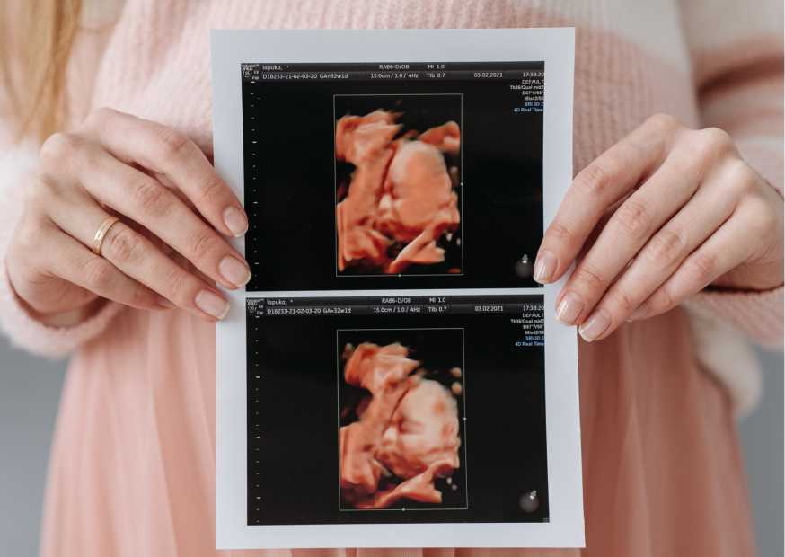 موت الجنين داخل الرحم موت الجنين داخل الرحم